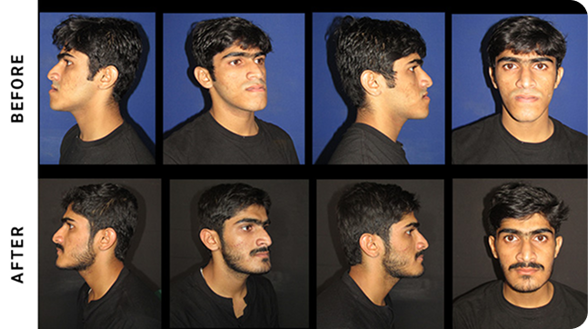 Before Surgery